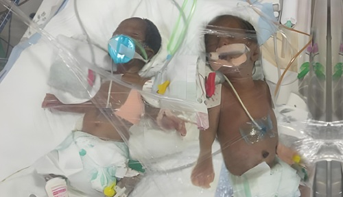 A Double Miracle, A Fight for Every Breath: Help Mythri's Twins Thrive!